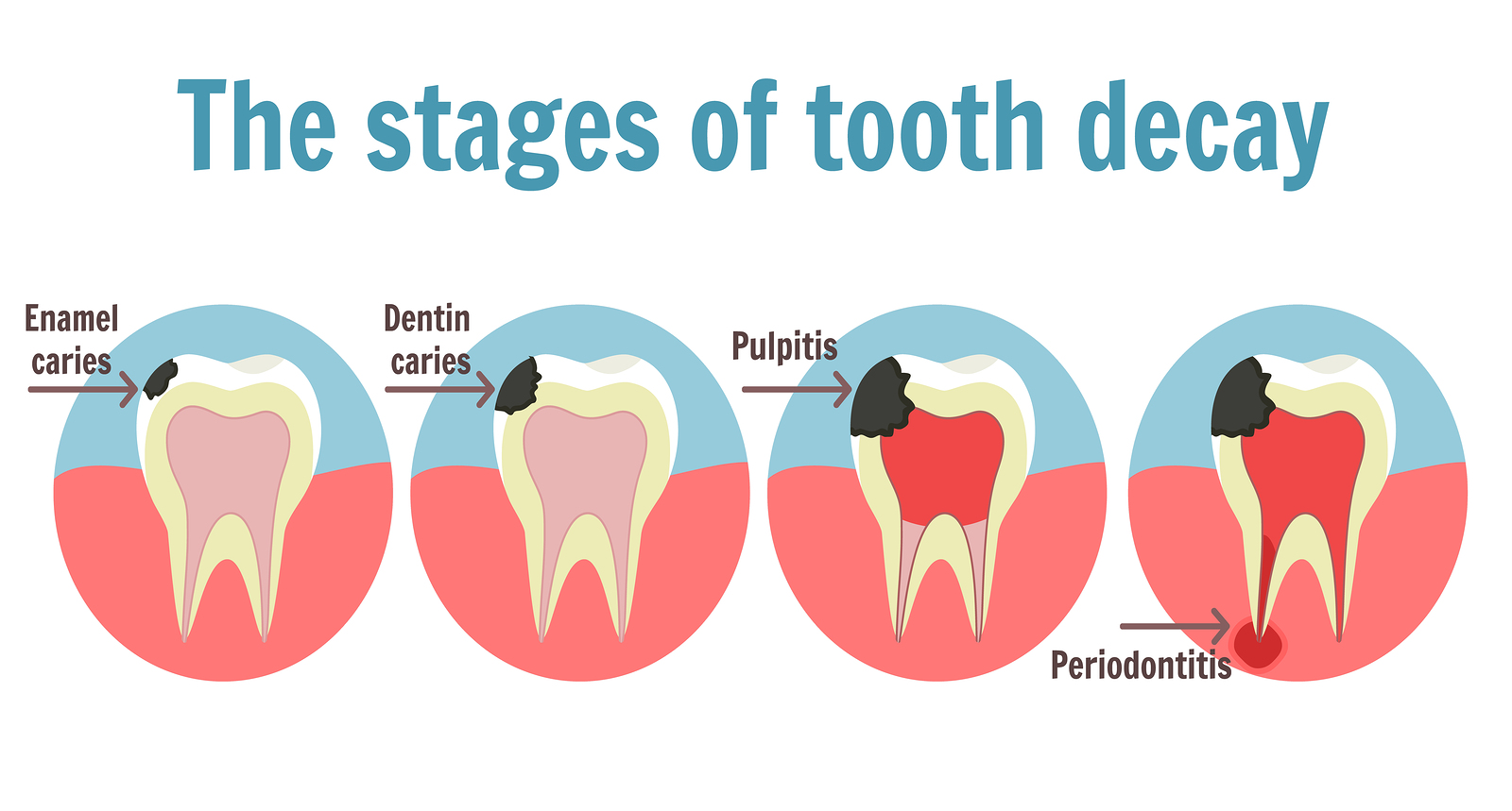 bigstock-The-Stages-Of-Tooth-Decay-Info-193925746 bigstock-The-Stages-Of-Tooth-Decay-Info-193925746