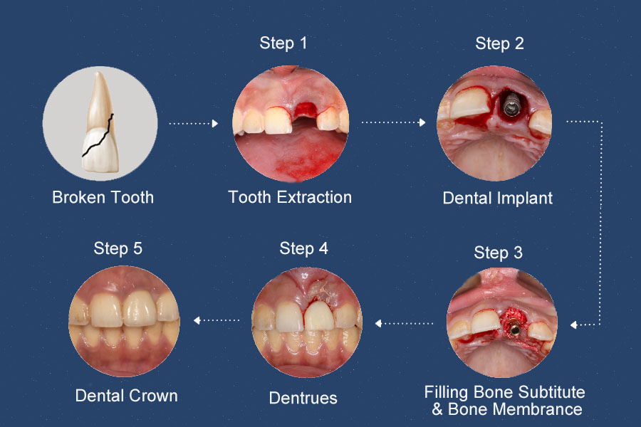 ImmediateImplantPlacement