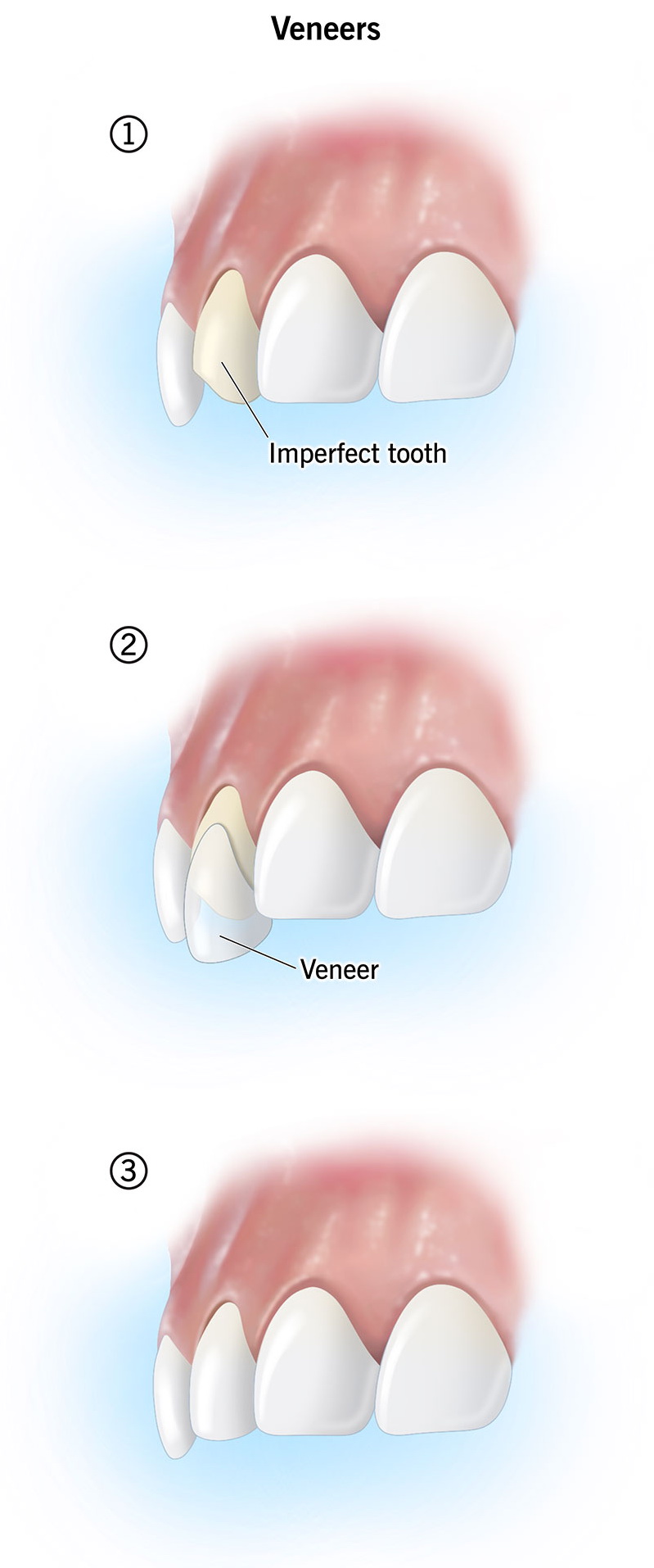 23522-dental-veneer 23522-dental-veneer