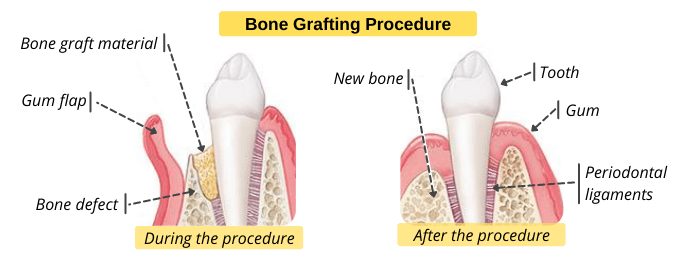 Bone-Grafting-for-the-Treatment-of-Periodontitis Bone-Grafting-for-the-Treatment-of-Periodontitis