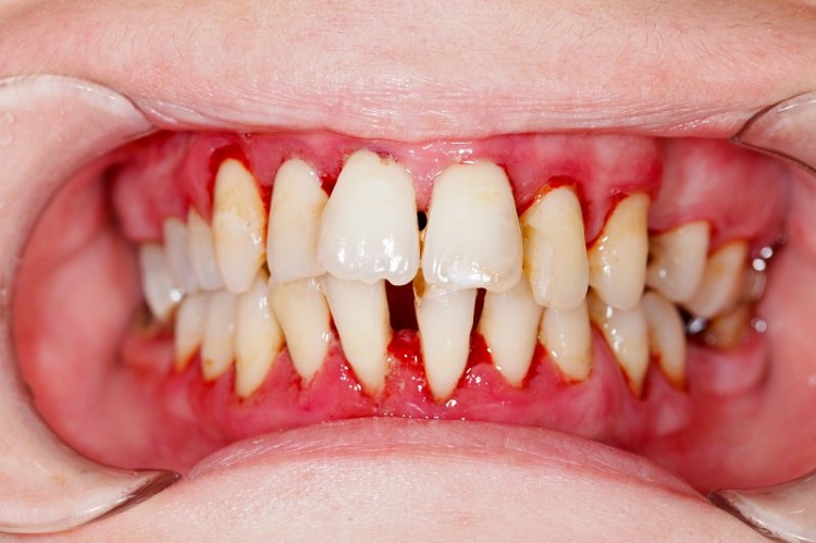 Mengenal-penyebab-dari-periodontitis.jpg Mengenal-penyebab-dari-periodontitis.jpg