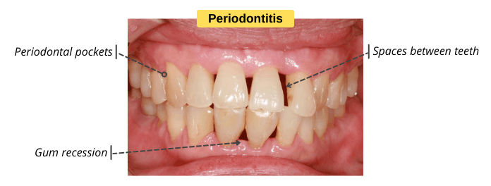 Signs-Symptoms-of-Periodontitis.png Signs-Symptoms-of-Periodontitis.png