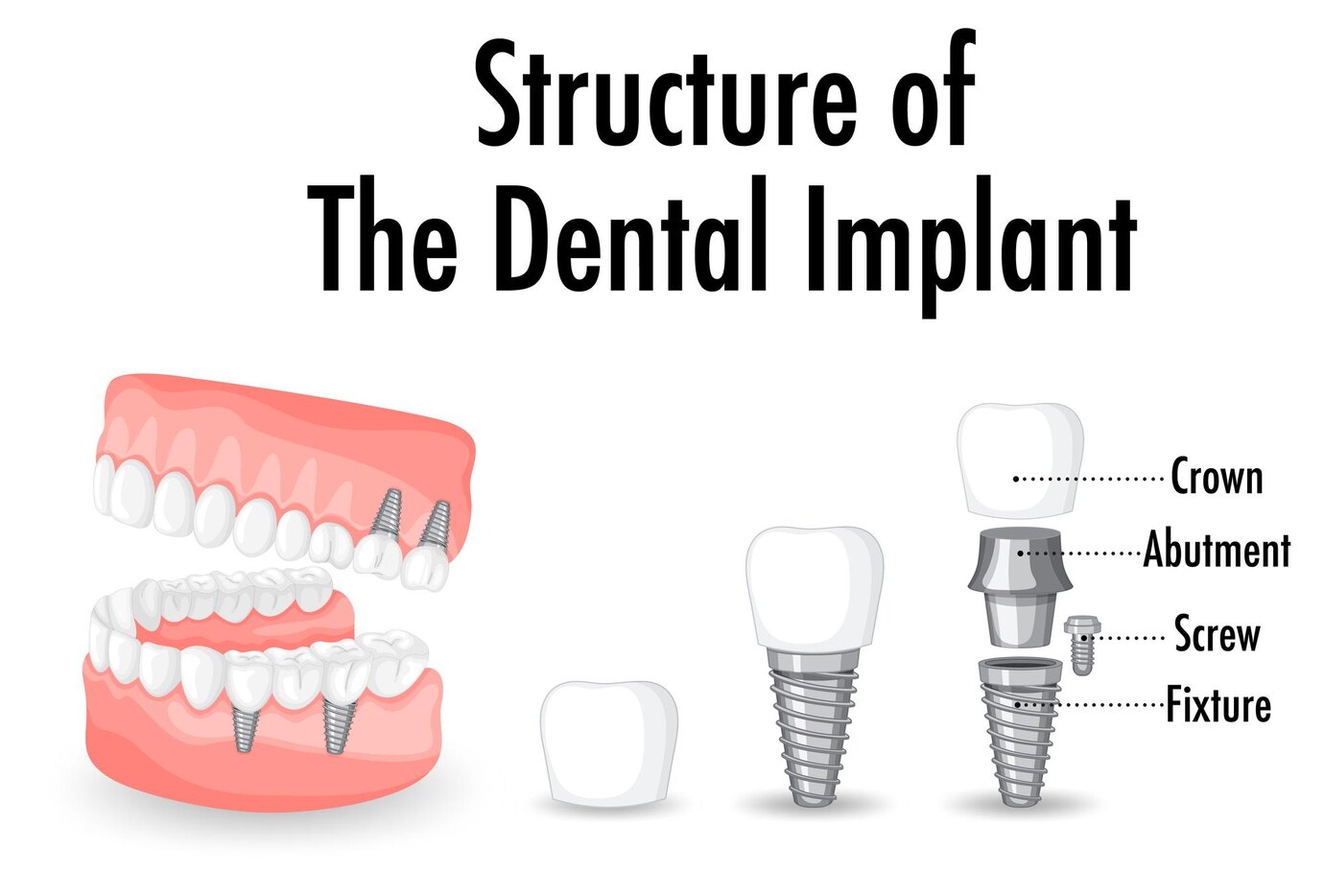infographic-human-structure-dental-implant_1308-93133-1.jpg infographic-human-structure-dental-implant_1308-93133-1.jpg