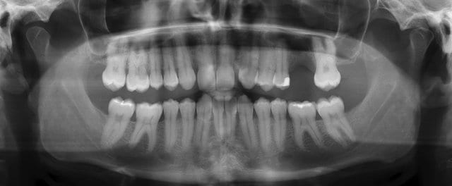 Secondmolarteethlost.jpg Secondmolarteethlost.jpg