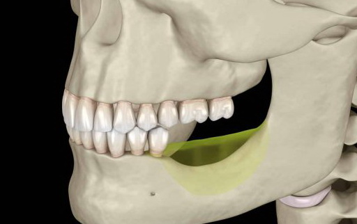 Alveolarboneatrophy.jpg Alveolarboneatrophy.jpg