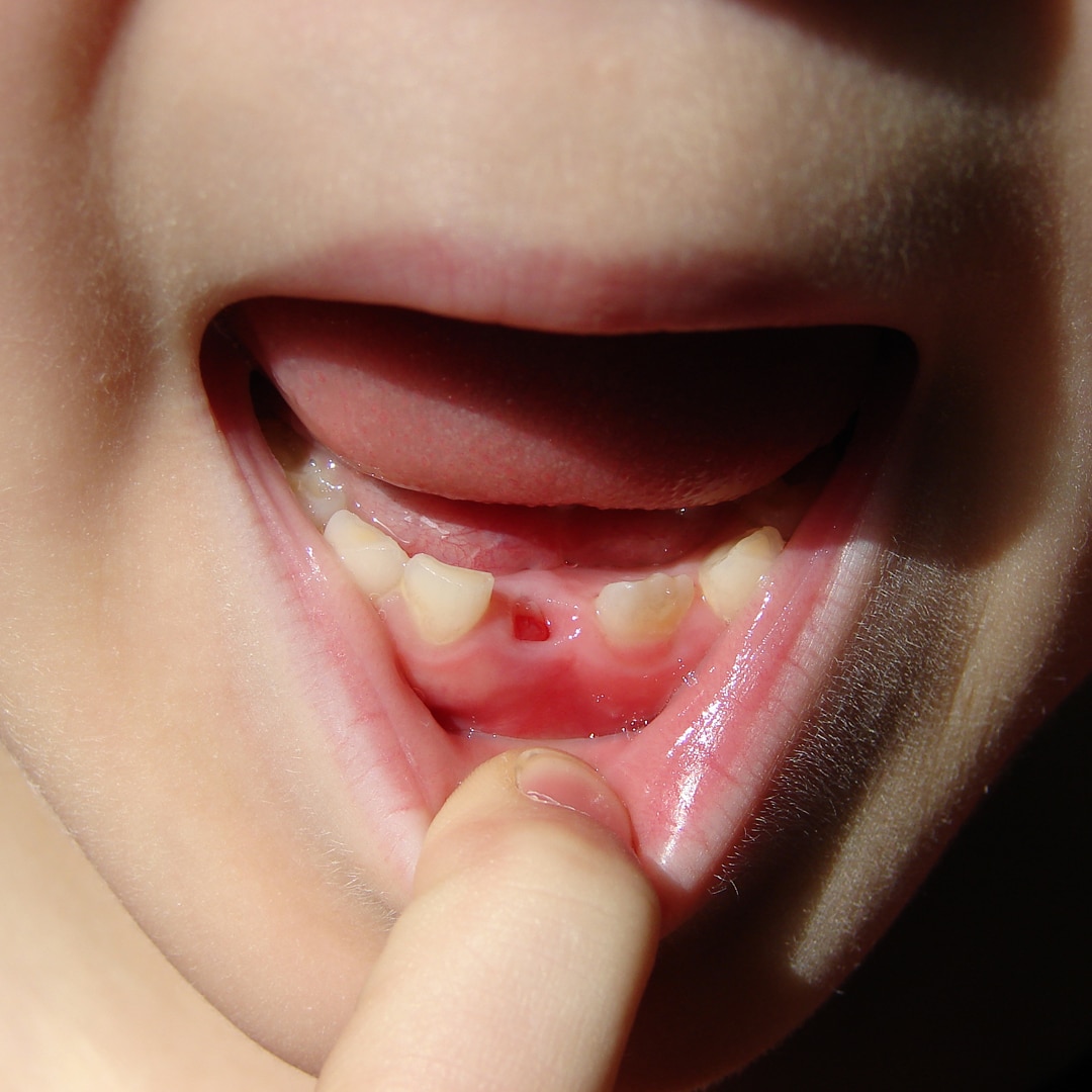 ToothLost.jpg ToothLost.jpg