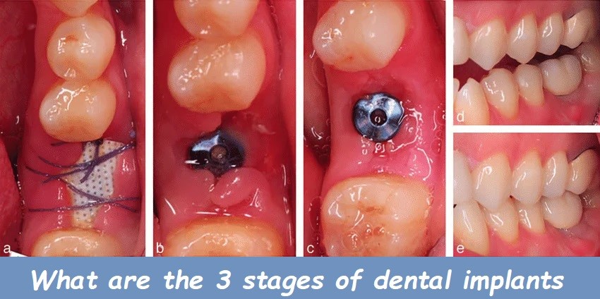dental implants dental implants