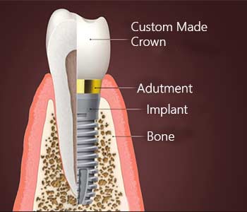 Single-Missing-Tooth Single-Missing-Tooth