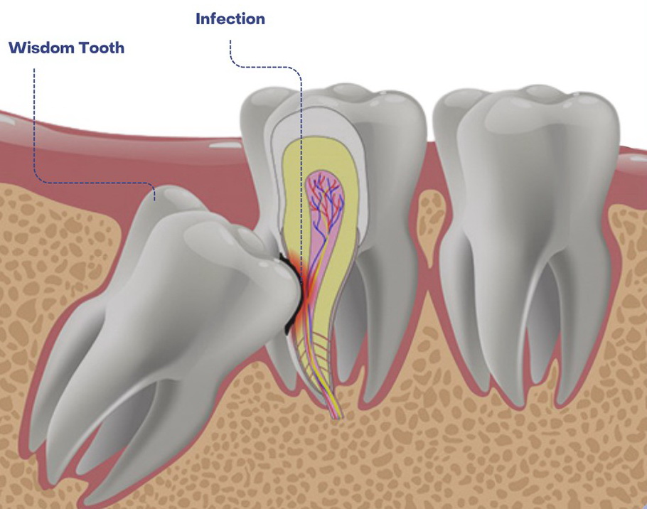 wisdom tooth infection wisdom tooth infection