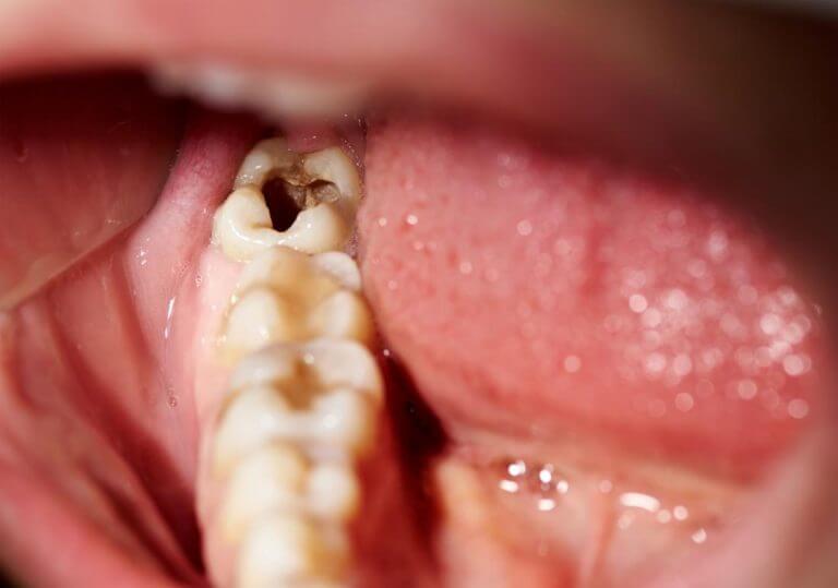tooth-decay-wisdom tooth-decay-wisdom