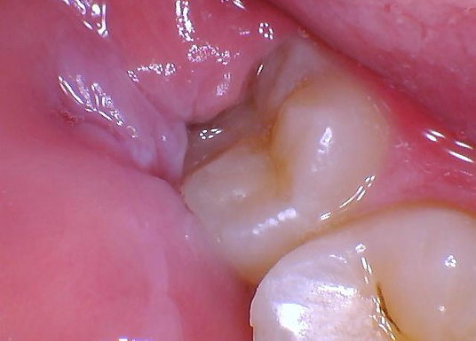 gum flap over wisdom tooth gum flap over wisdom tooth