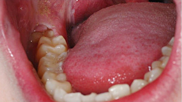 removal wisdom tooth1