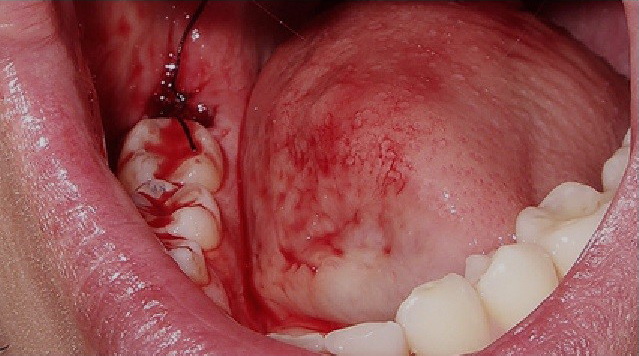 removal wisdom tooth2