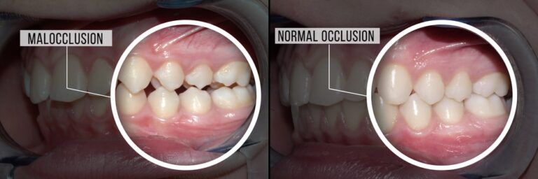 What-is-Malocclusion-and-How-Does-it-Affect-Your-Oral-Health-inner-1 What-is-Malocclusion-and-How-Does-it-Affect-Your-Oral-Health-inner-1