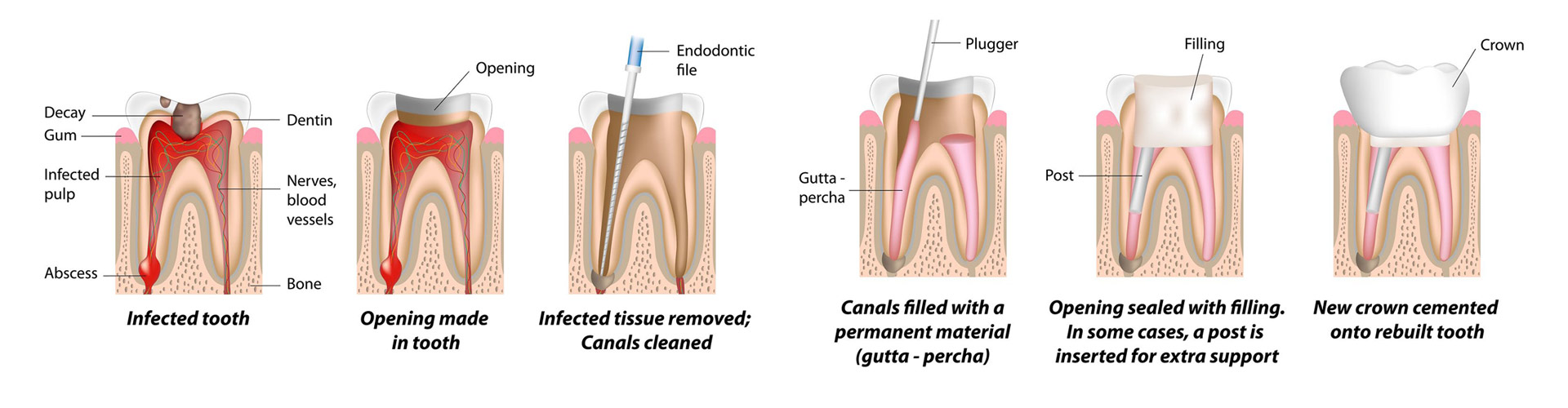 root-canal-process root-canal-process