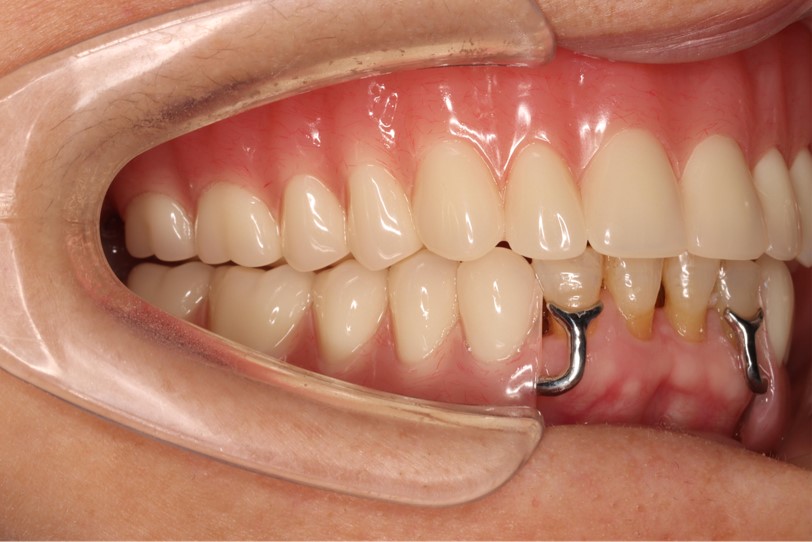 Tao denture 4 Tao denture 4