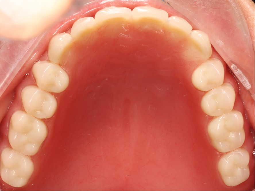 Tao denture 7 Tao denture 7