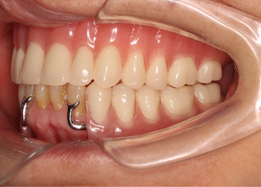 Tao denture 6 Tao denture 6