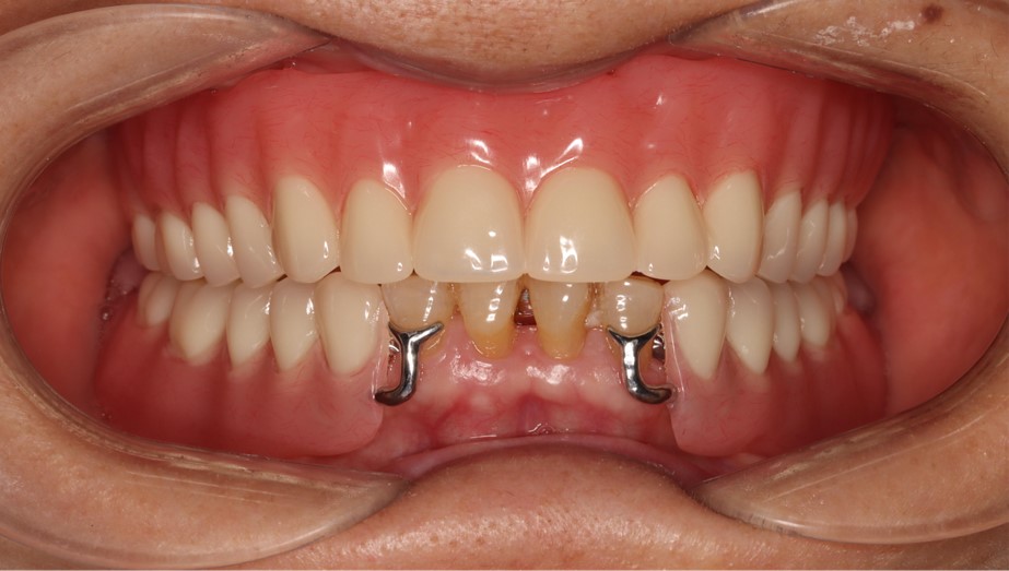 Tao denture 5 Tao denture 5