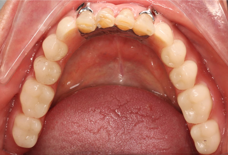 Tao denture 8 Tao denture 8