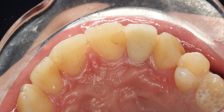 all-ceramic crown restoration12 all-ceramic crown restoration12