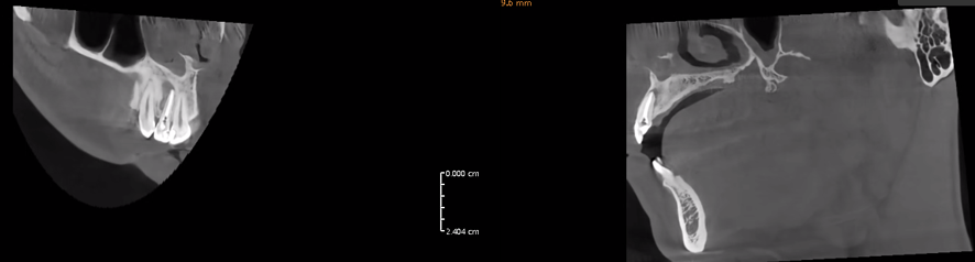 Follow-up ridiography Follow-up ridiography
