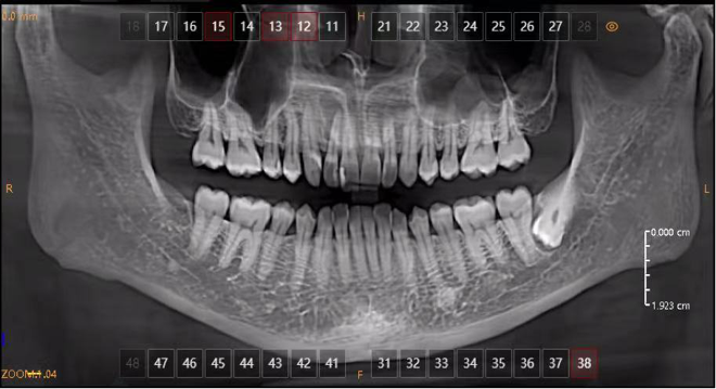 periapical cyst Panoramic radiograph periapical cyst Panoramic radiograph