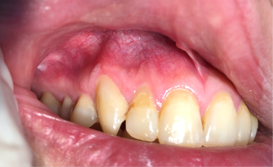 periapical cyst periapical cyst