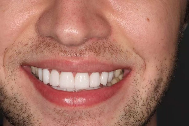 Ceramic Veneer Bondied1.jpg Ceramic Veneer Bondied1.jpg