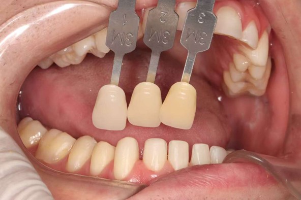 shade selection2 shade selection2