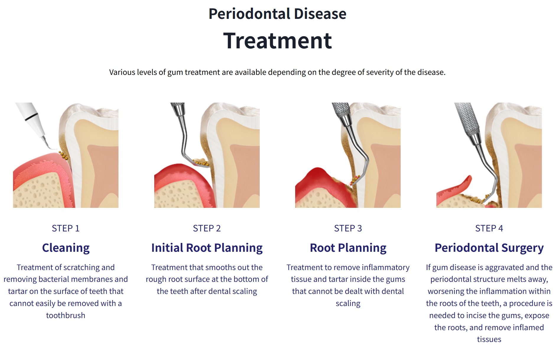 Periodontal disease Treatment Periodontal disease Treatment