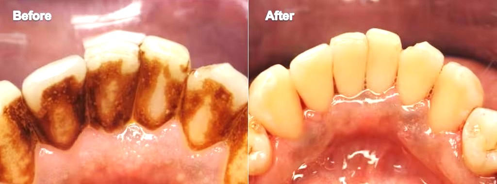 non-surgical-periodontal-treatment non-surgical-periodontal-treatment