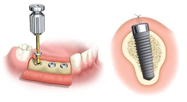 vis-de-coverture-suba-dental-implantation-dentaire