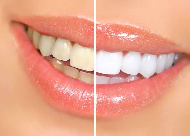 whitening