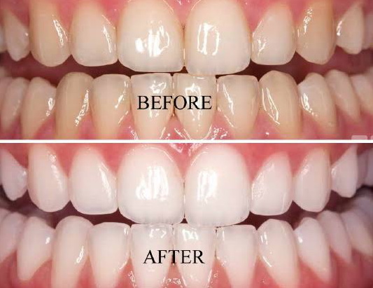 teeth whitening2